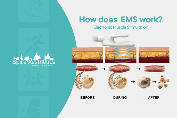EMS treatment for post pregnancy weight loss treatment Theale