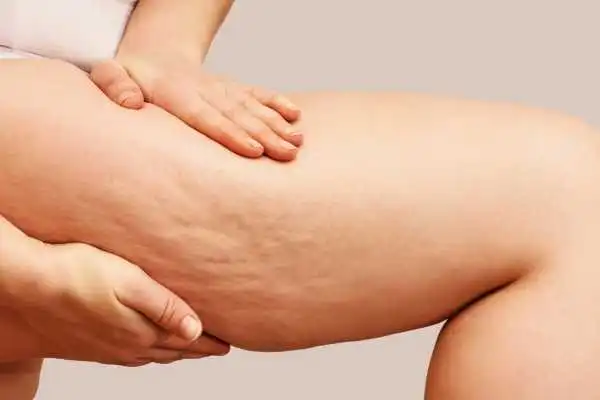 Image of woman showing leg with cellulite Theale