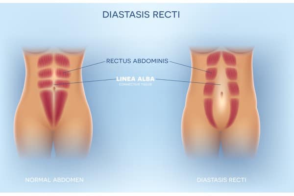 What Non-Surgical Options Are Available for Diastasis Recti Theale?