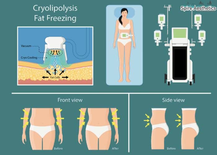 Image of diet and fat freezing combined for best results for Spire Aesthetics Theale