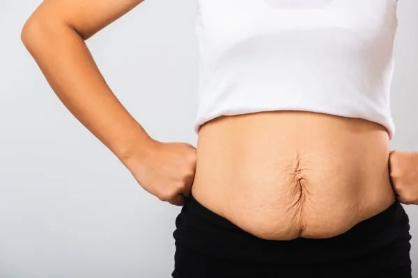 Image of a woman's stomach after weight loss with sagging skin following a gastric band Theale