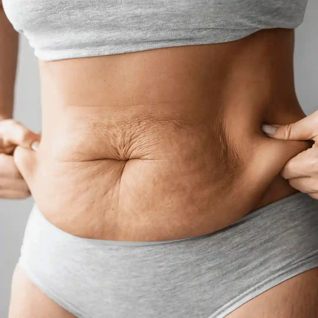 Is It Normal to Have Loose Skin After Pregnancy Theale?