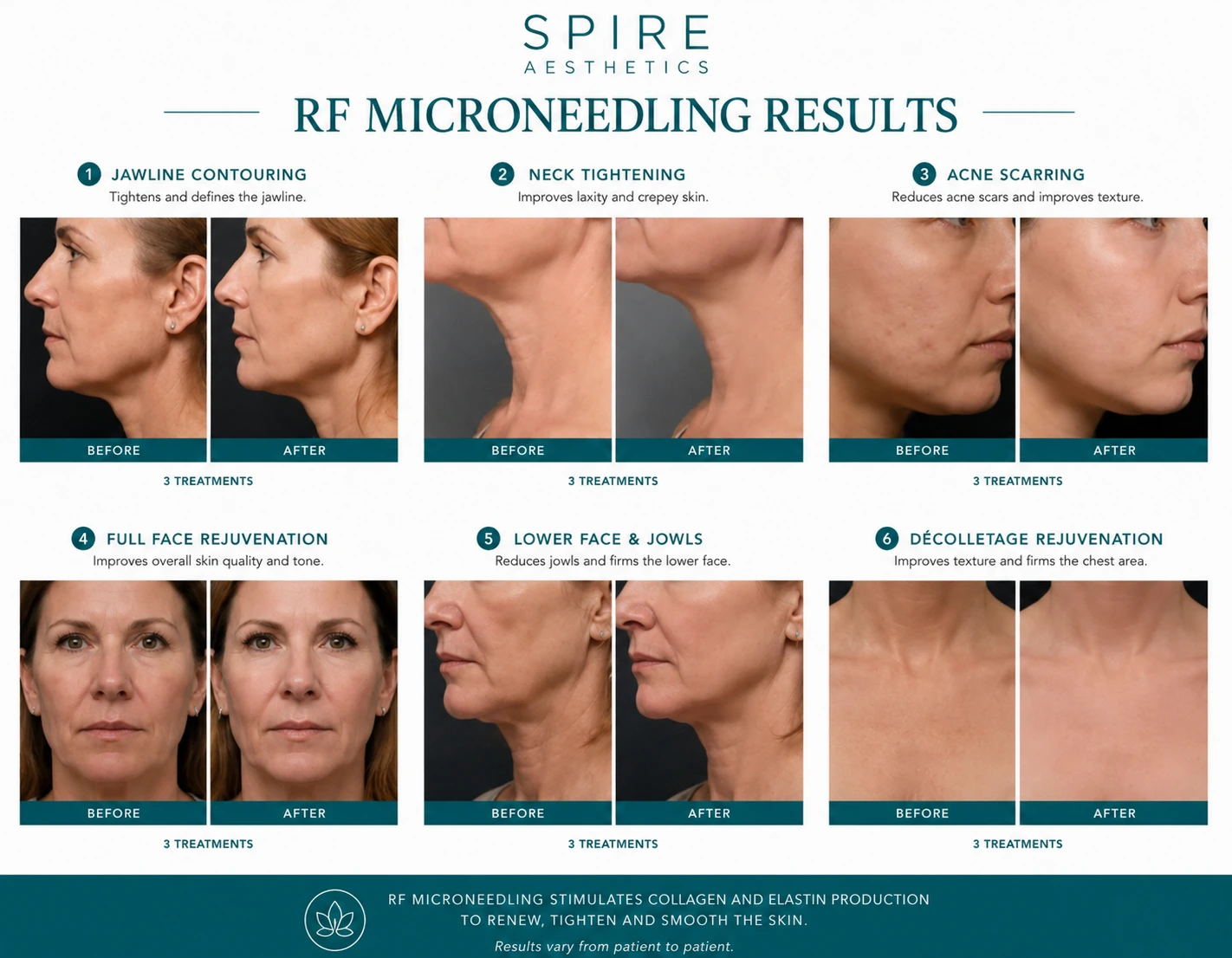 RF Microneedling Skin tightening Theale results