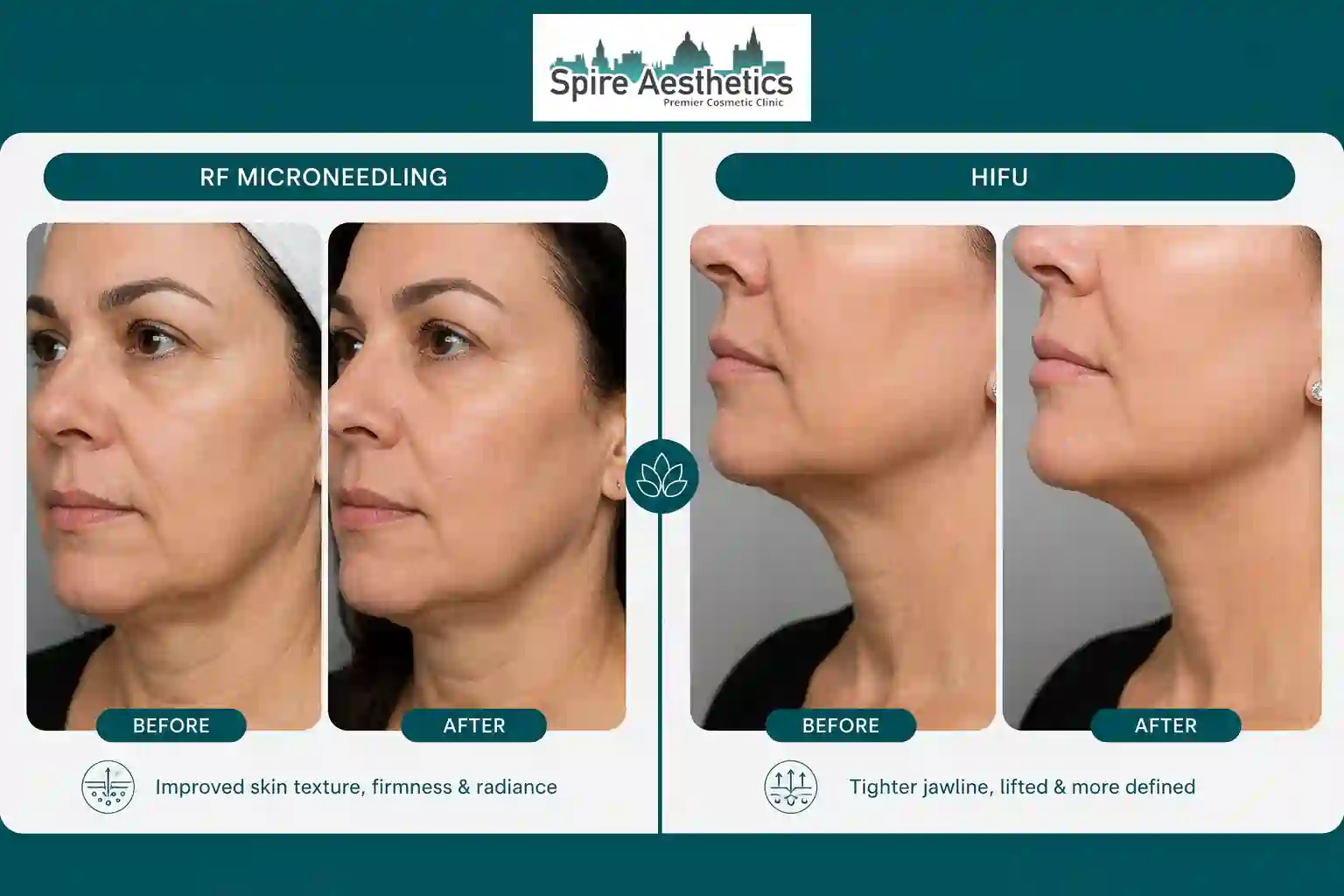 Can RF Microneedling and HIFU Be Combined Theale?