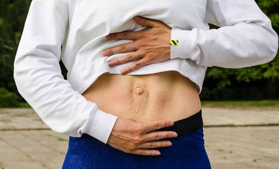 When Could Diastasis Recti Be the Missing Piece of the Puzzle Theale?