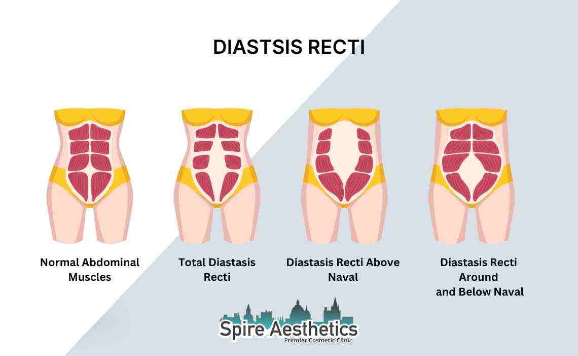 Is Non-Surgical Diastasis Recti Treatment Right for You? Common Concerns Answered Theale